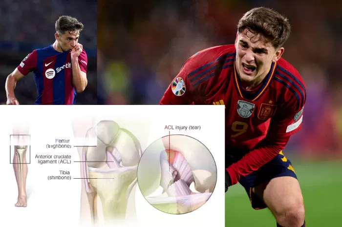 Penanganan Cedera Ligamen Anterior Cruciate Ligament (ACL)